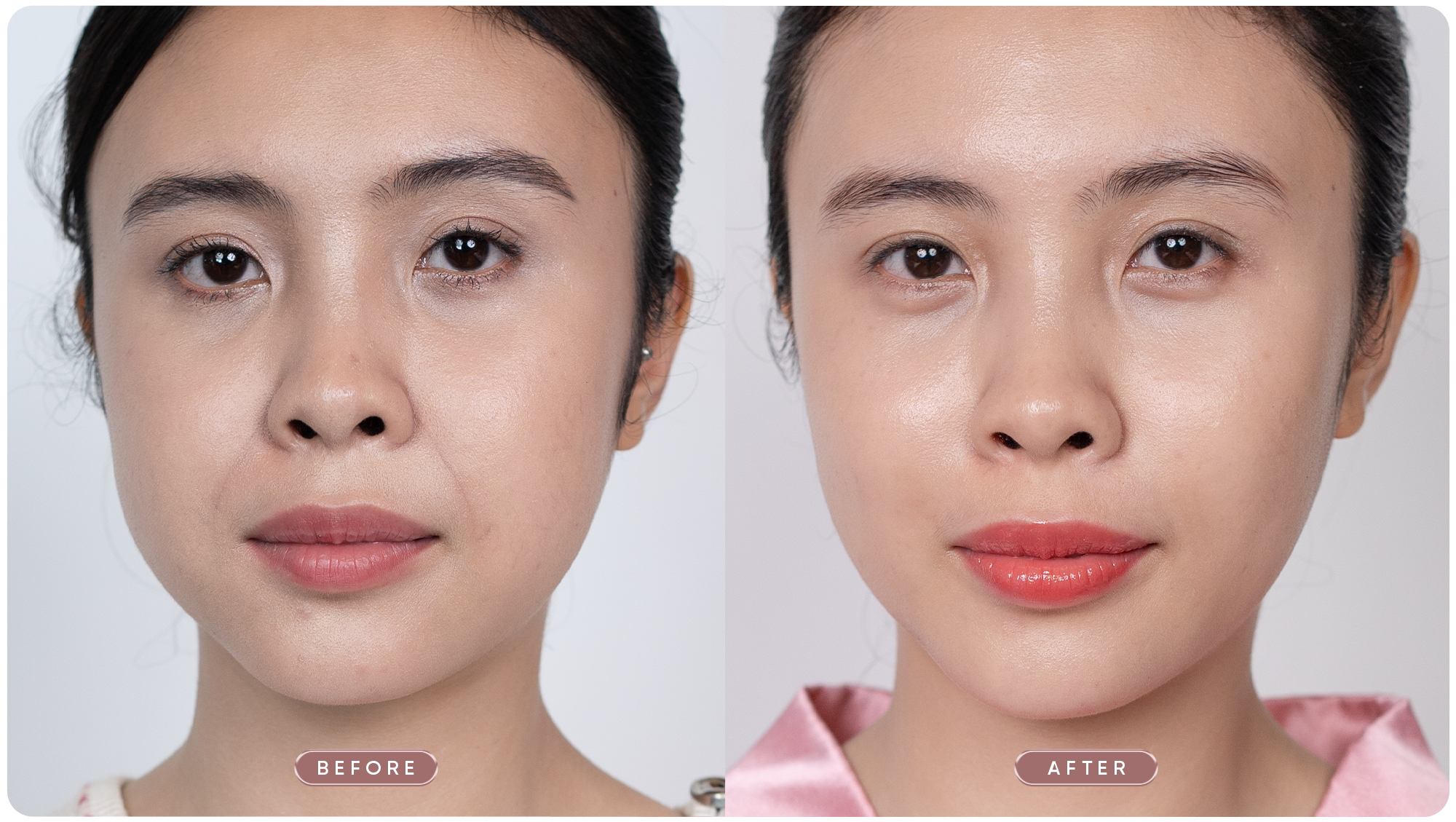 Nâng cơ & xóa nếp nhăn với phác đồ Shynh Perfect Face 26