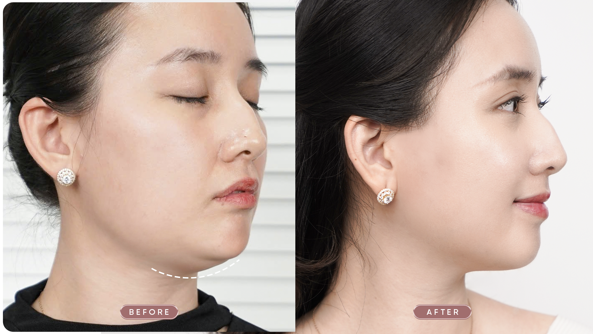 Kiến tạo viền hàm & định hình gương mặt với phác đồ Shynh Perfect Face 26