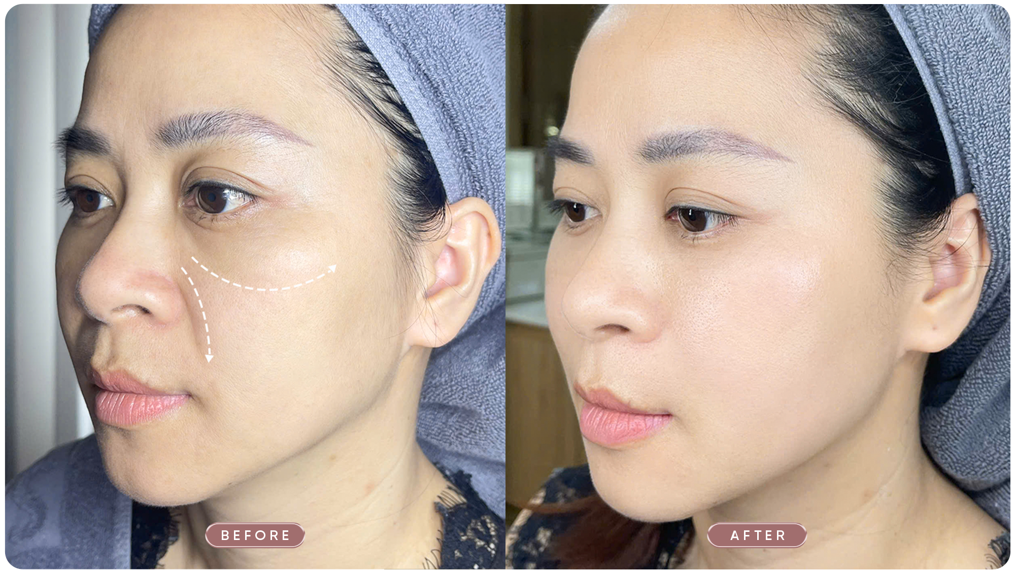 Nâng cơ, xóa nhăn & định hình gương mặt với phác đồ Shynh Perfect Face 26