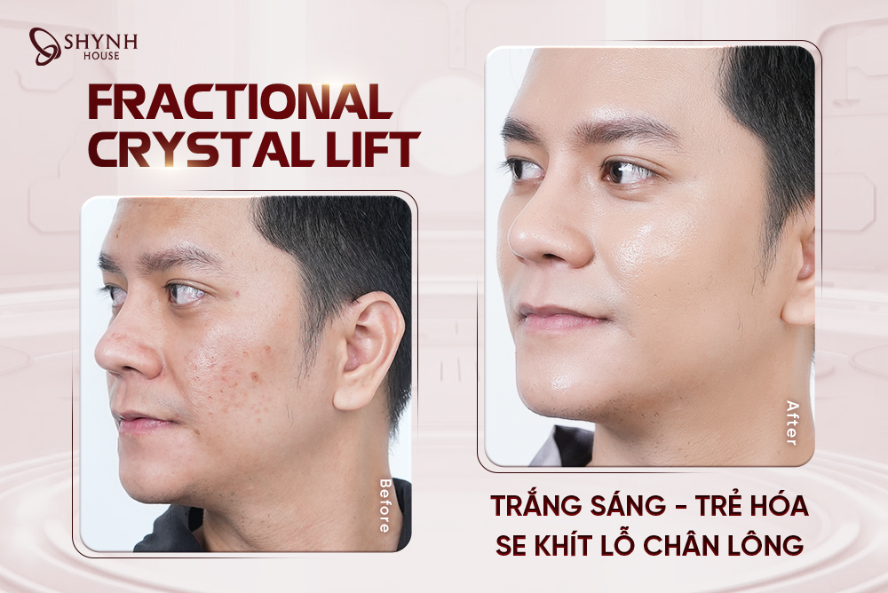 Fractional Crystal Lift – Phác đồ đỉnh cao tái sinh làn da tại Shynh House