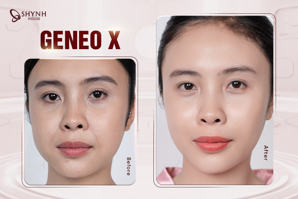 GENEO X – Tăng Cường Oxy Nội Sinh, Trải Nghiệm Làm Đẹp Đẳng Cấp Tại Shynh House