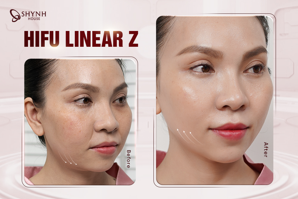 HI TRULIFT PRO – “Vũ Khí” Trẻ Hóa Làn Da Và Định Hình Gương Mặt Chuẩn V-Line
