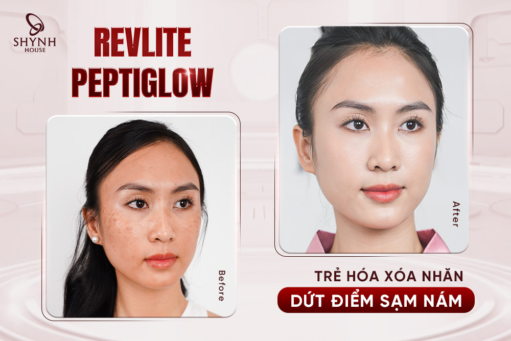 Đánh bay sạm nám lâu năm với Revlite PeptiGlow – Phác đồ độc bản tại Shynh House