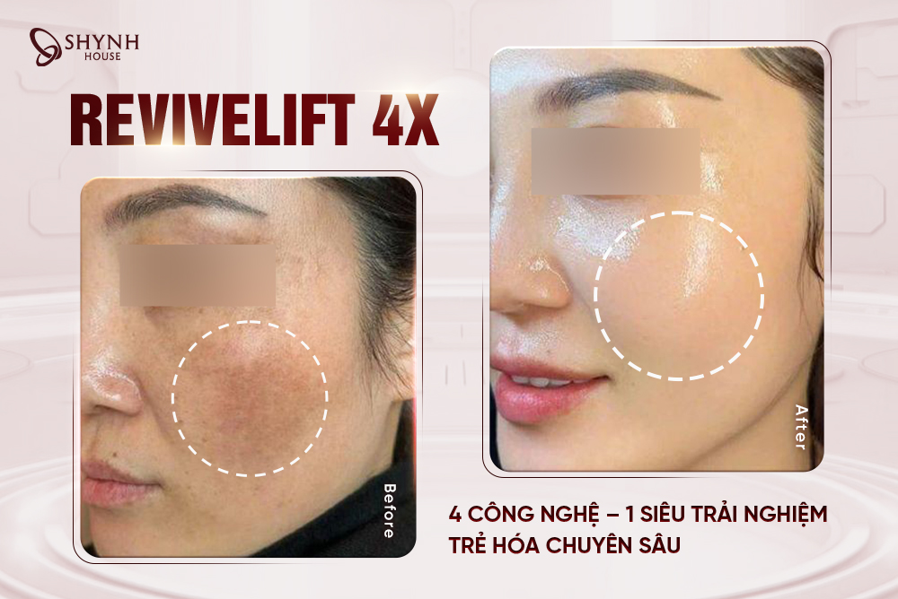 REVIVELIFT 4X: Giải Pháp Trẻ Hóa Toàn Diện, Chuyên Sâu Chuẩn Y Khoa Tại Shynh House