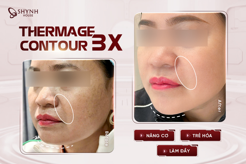 Trẻ ra 10 tuổi với Combo đa năng Nâng Cơ, Trẻ Hóa, Làm Đầy Tự Nhiên – Thermage Contour 3x tại Shynh House
