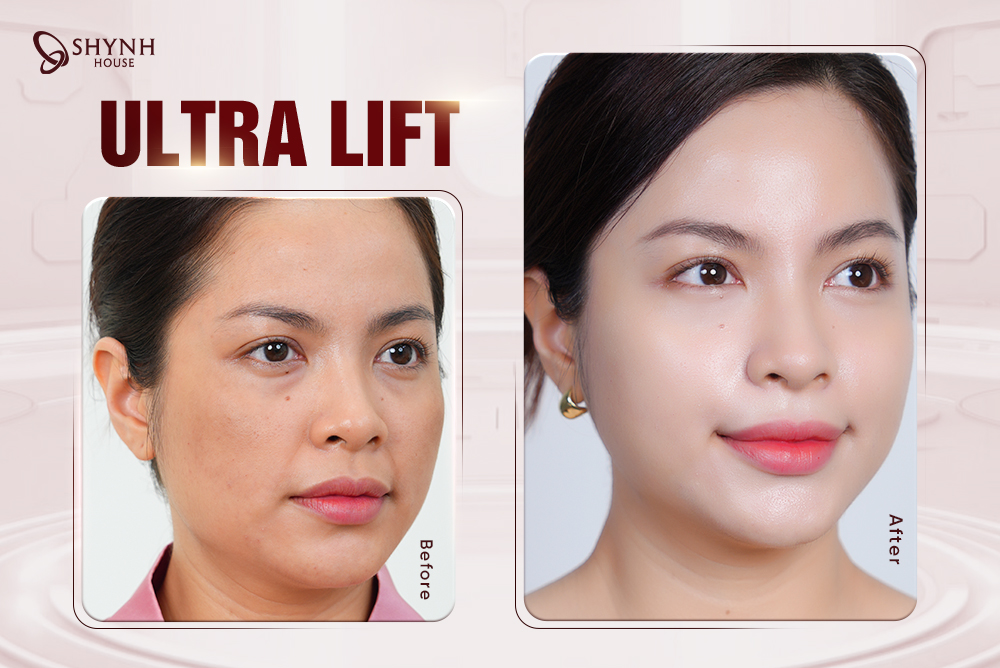 Ultra Lift – Bí quyết lão hoá ngược chỉ có tại Shynh House