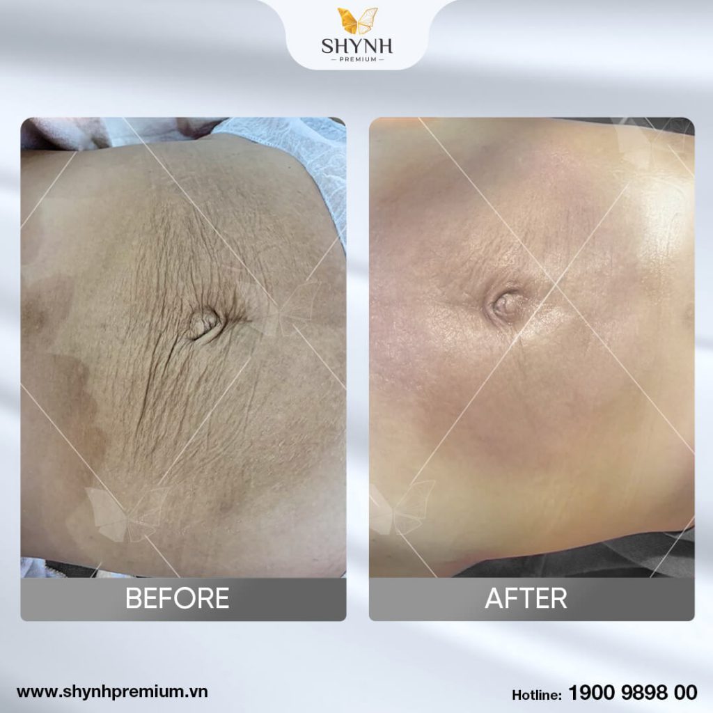Khách hàng thực hiện giảm mỡ Exilis 4.0 5