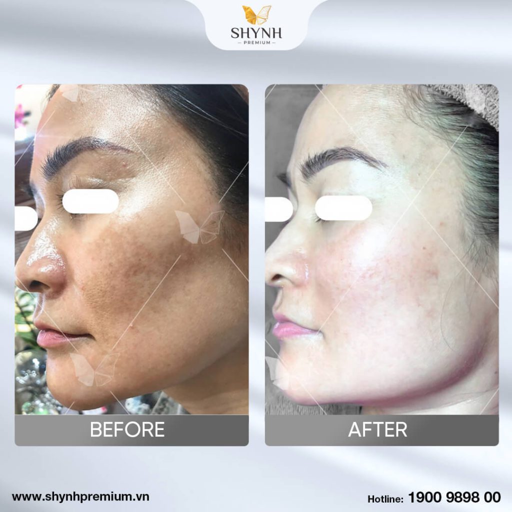 Trước và sau khi sử dụng trị nám New Perfect Skin 2