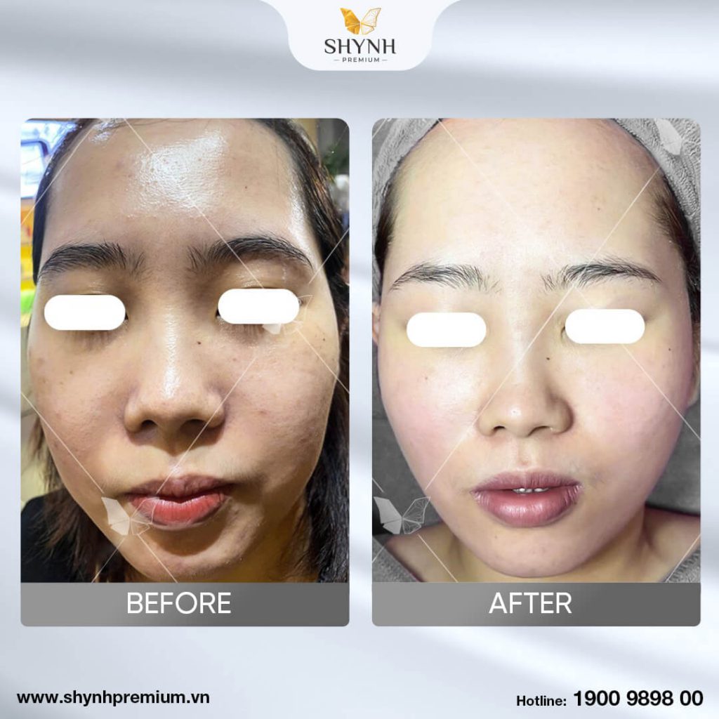 Trước và sau khi sử dụng trị nám New Perfect Skin 4