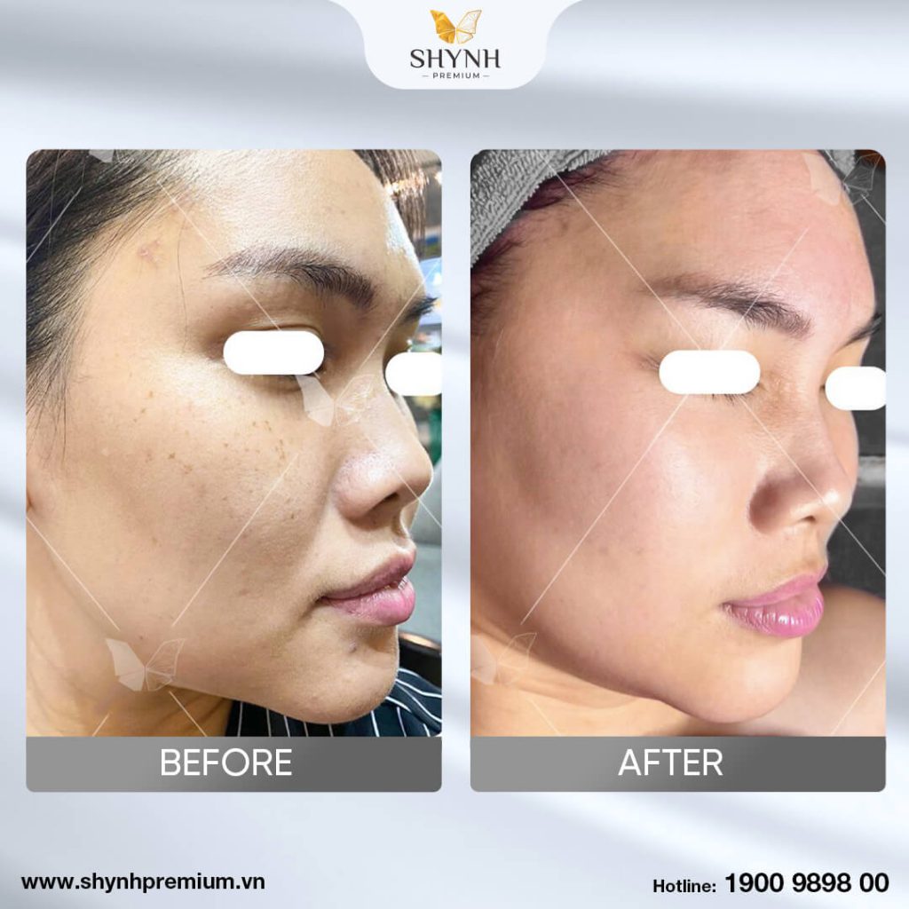 Trước và sau khi sử dụng trị nám New Perfect Skin 5