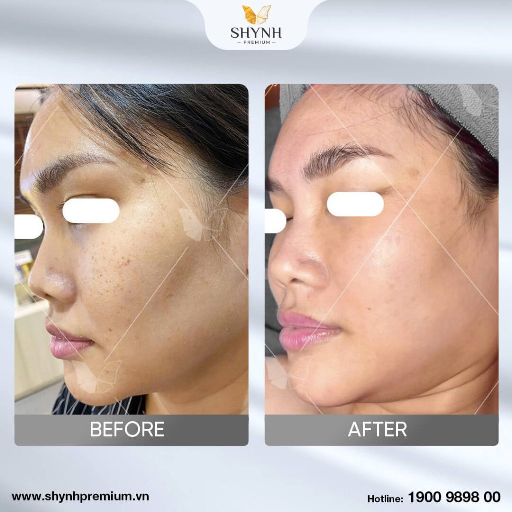 Trước và sau khi sử dụng trị nám New Perfect Skin 6