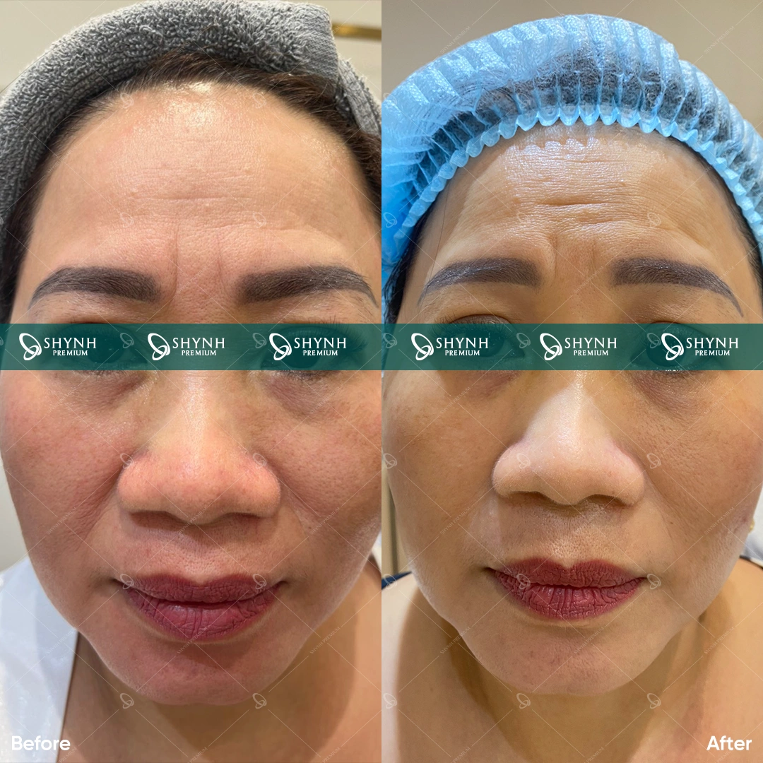 Công nghệ Thermage