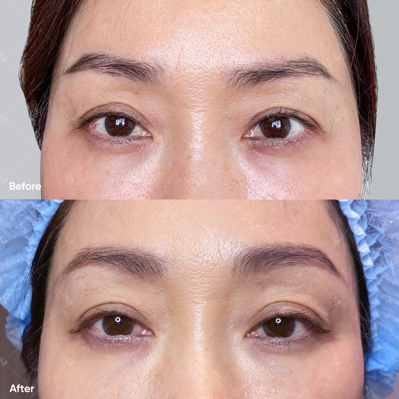 Thermage và Hifu là hai công nghệ thẩm mỹ có ưu điểm nhất định