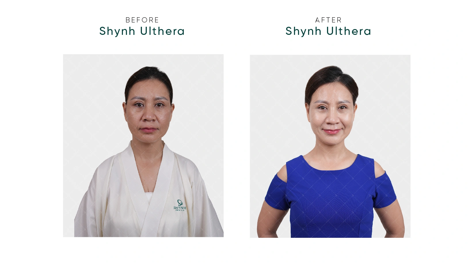 Shynh Ulthera - nâng cơ xoá nhăn hiệu quả