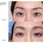 Hình ảnh khách hàng thực tế điều trị Thermage tại Shynh Premium