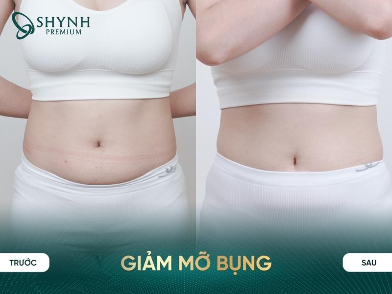 Hiệu quả điều trị Cooltech Define Pro Plus tại Shynh Premium