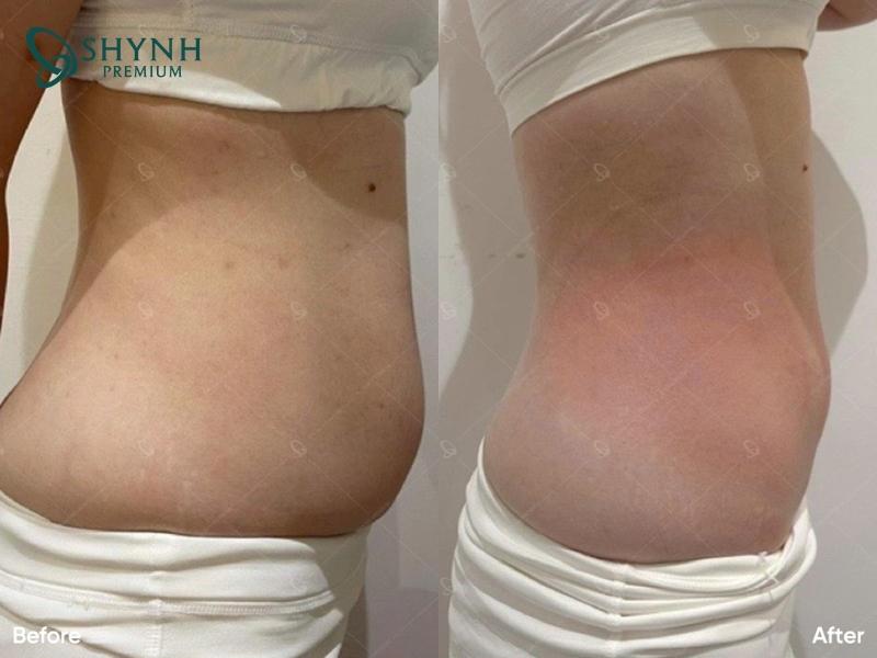 Thay đổi vòng eo rõ rệt với liệu pháp Exilis