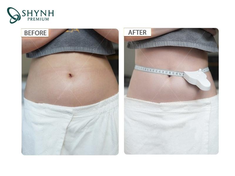Hình ảnh khách hàng sử dụng liệu pháp Shynh Meso Slim 24 