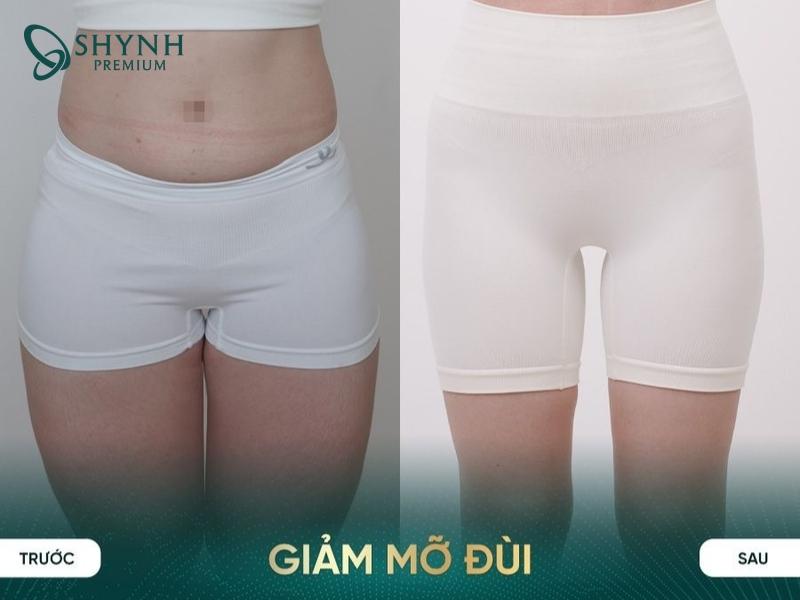 Hiệu quả giảm cân bằng Cooltech Define Pro Plus của khách hàng Shynh Premium
