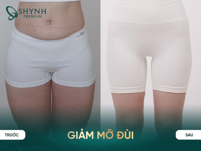 Thay đổi rõ rệt của khách hàng ở vùng đùi khi dùng liệu trình Cooltech Define Pro Plus