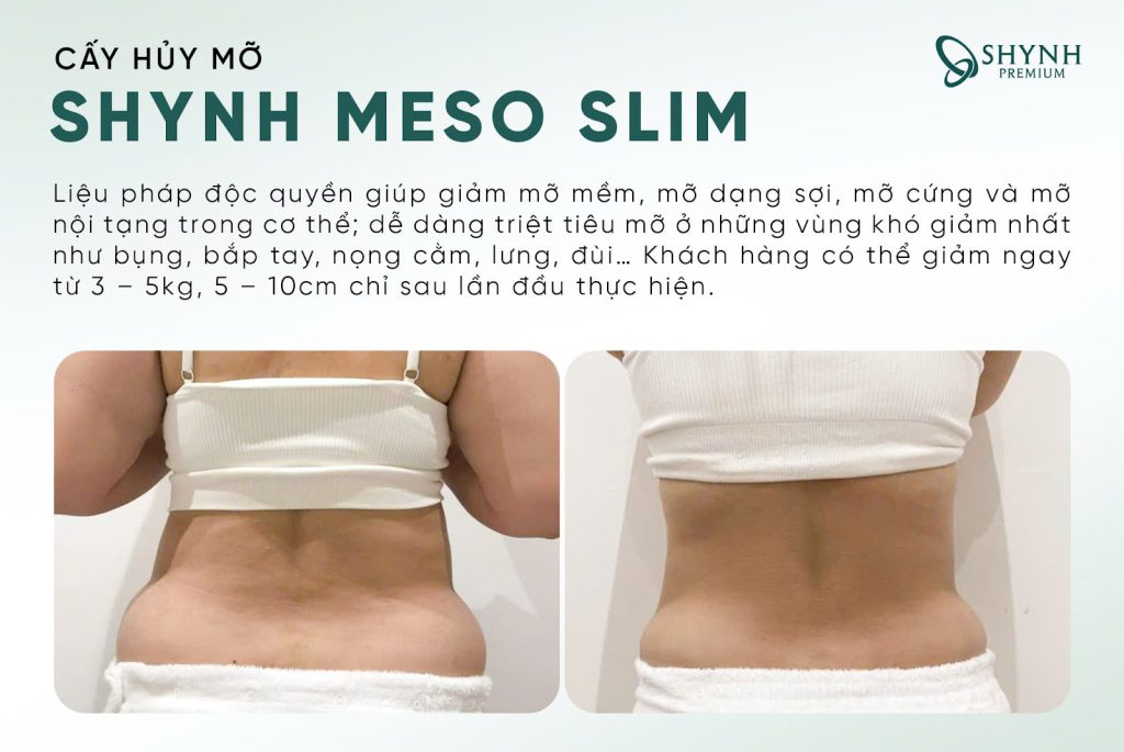 Khách hàng tại Shynh Premium giảm mỡ rõ rệt sau lần đầu thực hiện
