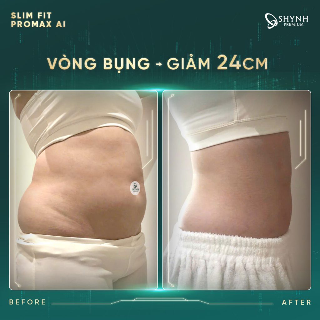 Khách hàng giảm đến 24 cm vòng bụng với phác đồ Slim Fit Promax AI
