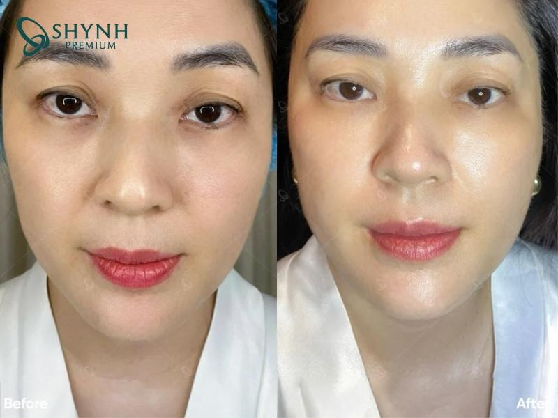 Gương mặt khách hàng thon gọn hơn nhờ Exion Tight của Shynh Premium