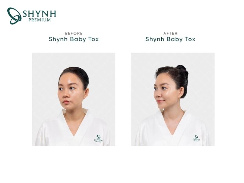 Khách hàng bất ngờ với kết quả cấy Protein tại Shynh Premium