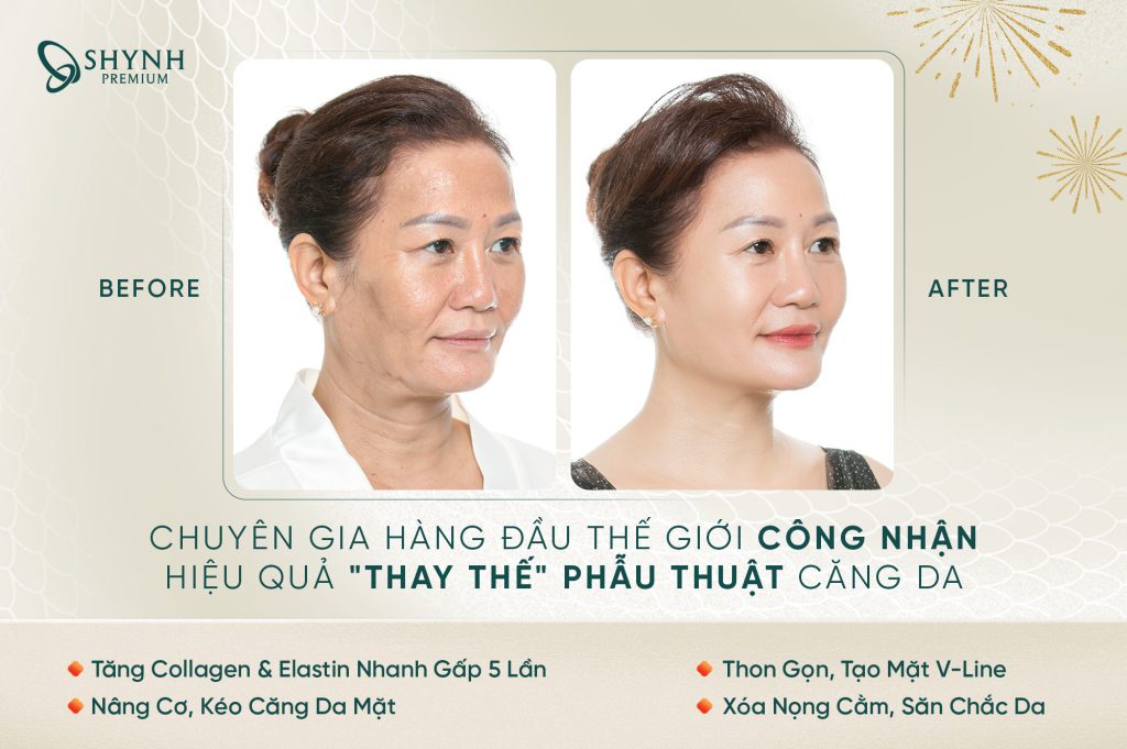 Ultherapy tác động đến tận lớp SMAS, giúp nâng cơ hiệu quả