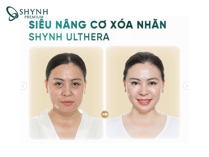 Sự thay đổi của khách hàng khi dùng liệu trình Shynh Ulthera tại Shynh Premium