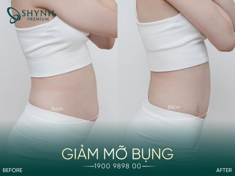 Exion tight giúp khách hàng Shynh Premium lấy lại vóc dáng thon gọn, săn chắc
