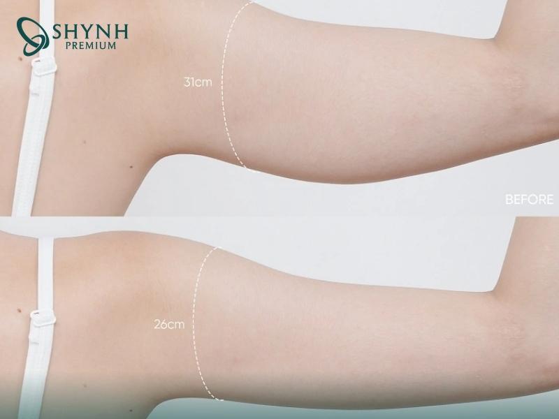 Hiệu quả rõ rệt của khách hàng khi dùng phương pháp Shynh Meso Slim 24 của Shynh Premium