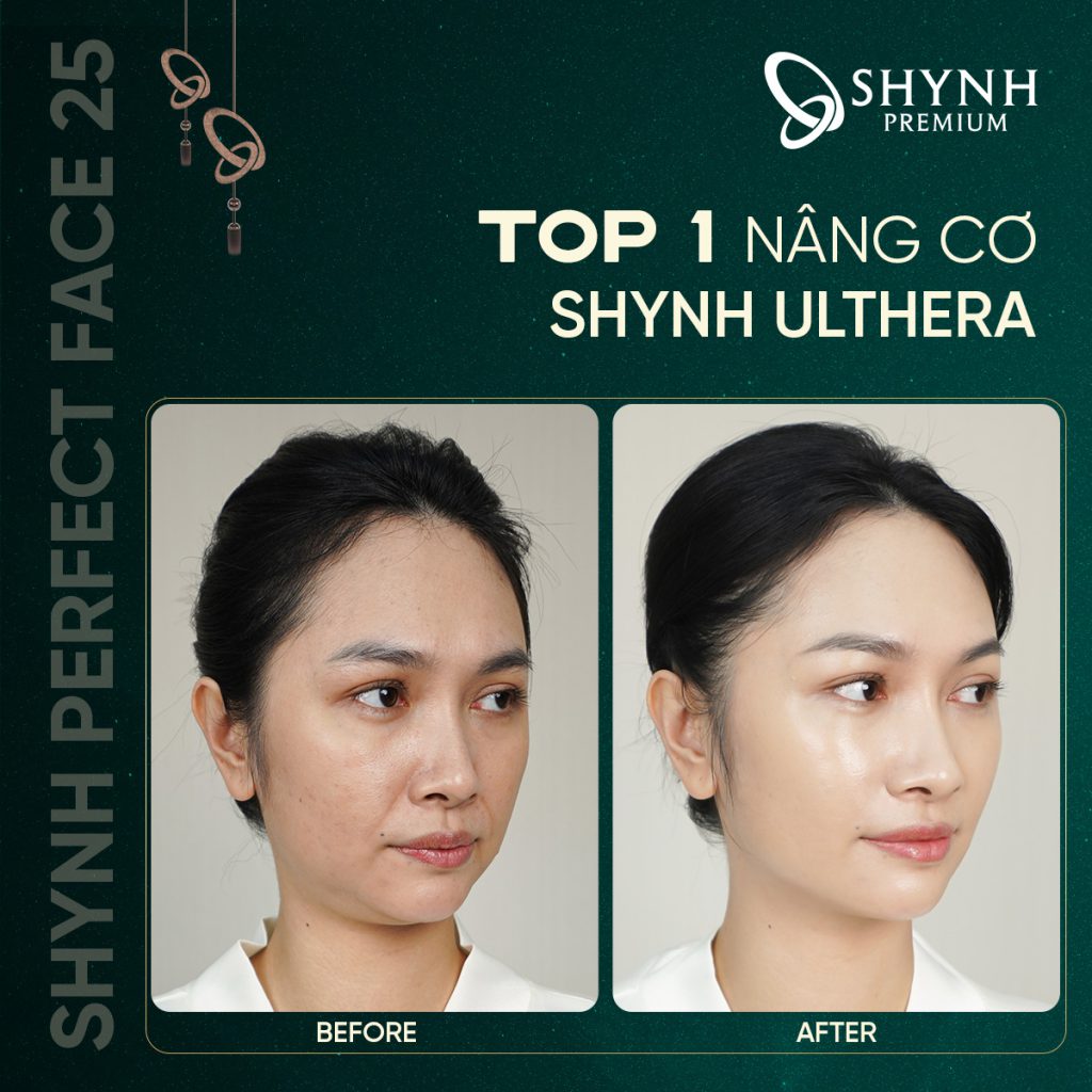 Hình ảnh khách hàng thay đổi sau khi dùng phác đồ Shynh Ulthera