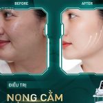 Hiệu quả điều trị rõ rệt của phác đồ Shynh Ulthera