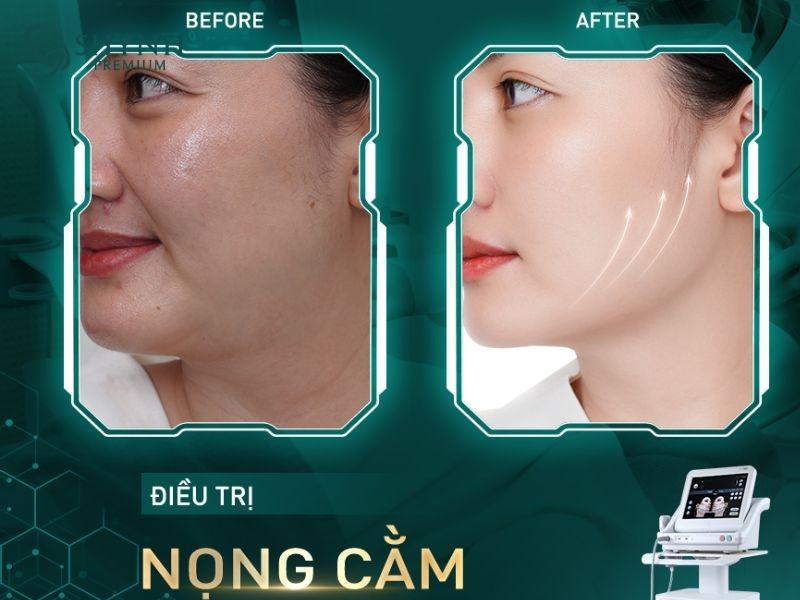 Hiệu quả điều trị rõ rệt của phác đồ Shynh Ulthera