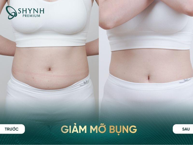 Hình ảnh thay đổi vòng bụng của khách hàng Shynh Premium