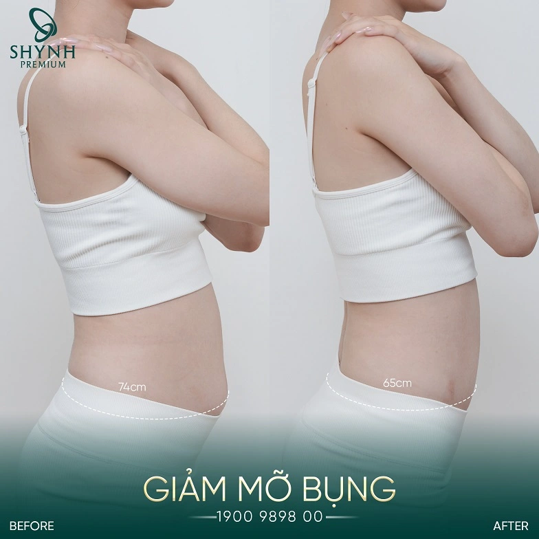 Hình ảnh khách hàng dùng liệu trình giảm béo bằng Exion Tight tại Shynh Premium