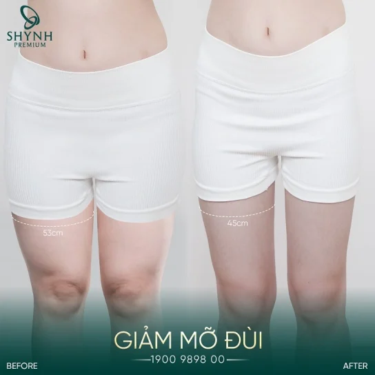 Shynh Meso Slim 24 giúp khách hàng Shynh Premium hồi dáng S-Line nhanh chóng