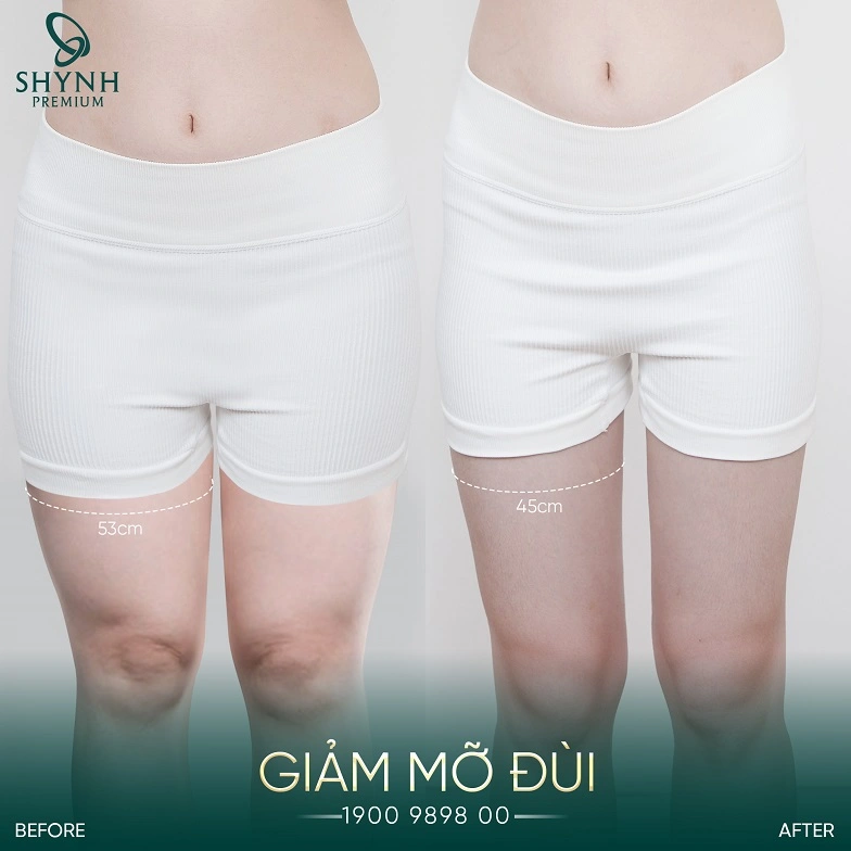 Shynh Meso Slim 24 giúp khách hàng Shynh Premium hồi dáng S-Line nhanh chóng