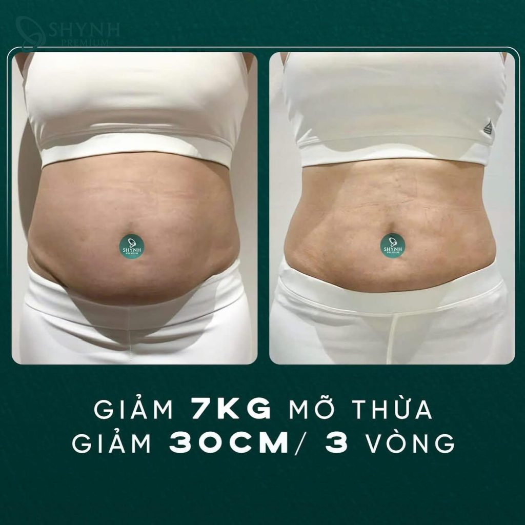 Chỉ sau một lần điều trị, công nghệ Cooltech Define Pro Plus giúp giảm đến 7kg