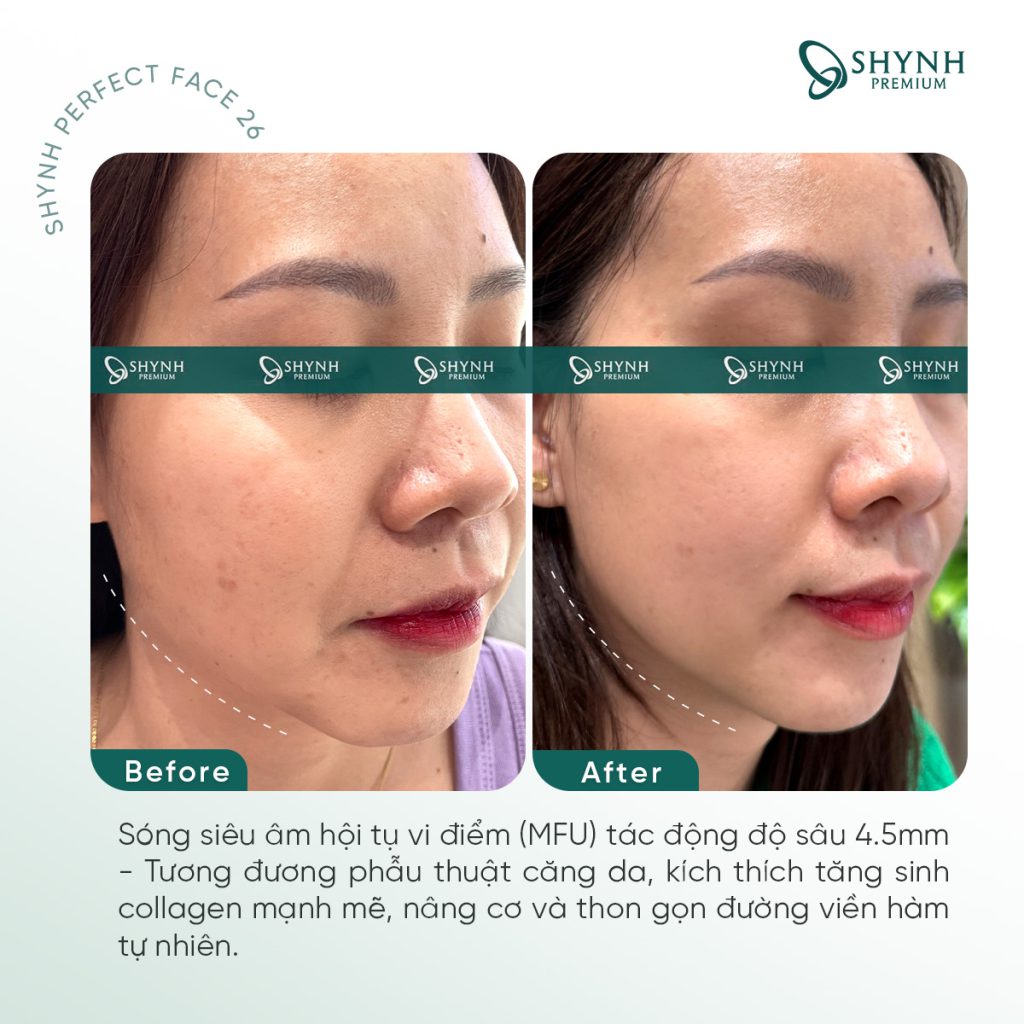 Hiệu quả làm đẹp gương mặt toàn diện của khách hàng sử dụng Shynh Perfect Face 26