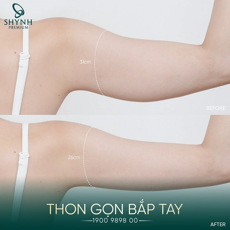 Khách hàng Shynh Premium giảm mỡ bắp tay rõ rệt khi điều trị Shynh Meso Slim 24
