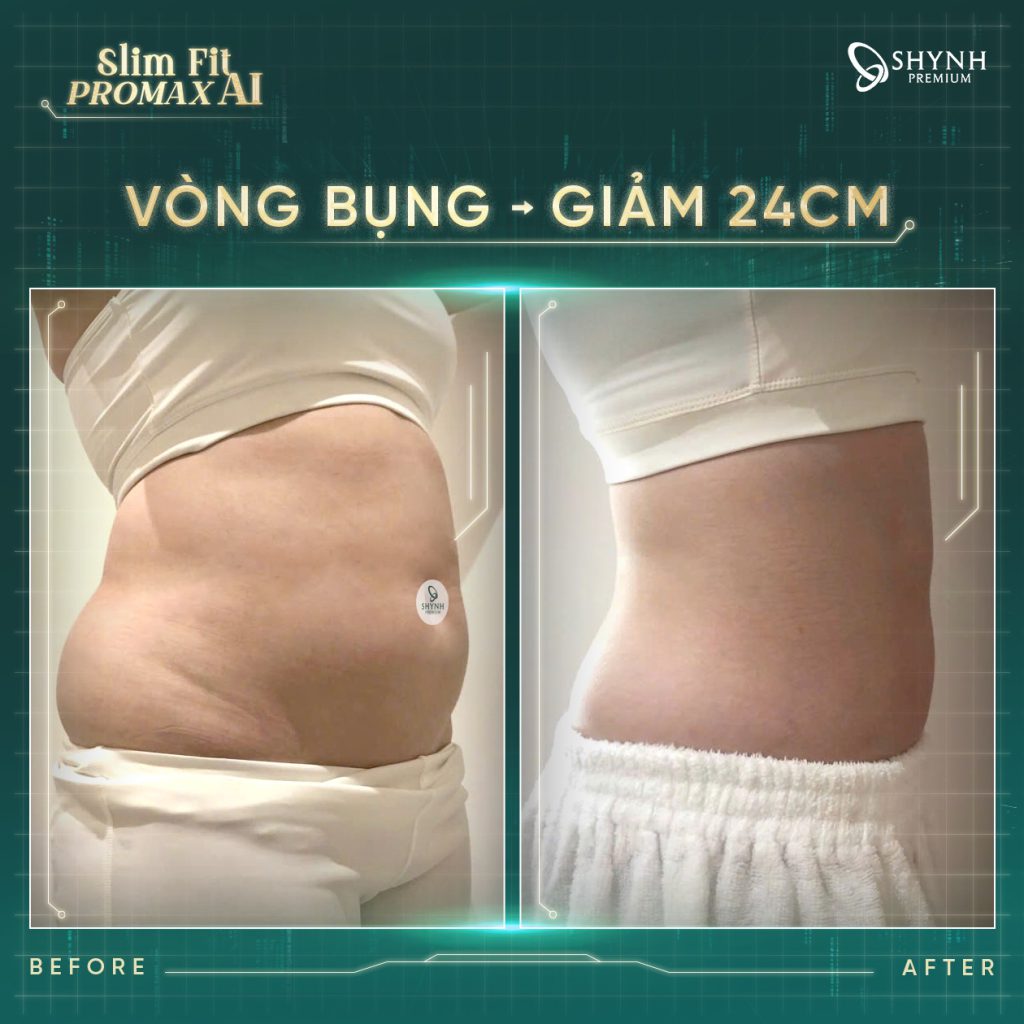 Hình ảnh hiệu quả rõ rệt của khách hàng khi sử dụng phác đồ Slim Fit Promax AI