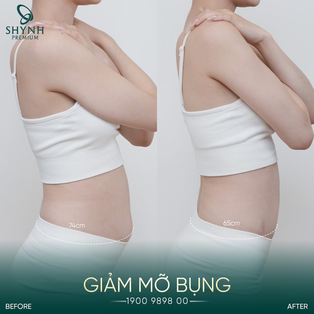 Thay đổi của khách hàng Shynh Premium sau điều trị Exion Tight