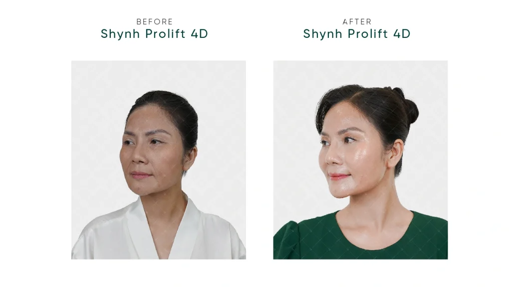 Làn da trẻ trung, căng khỏe của khách hàng Shynh Premium sau liệu pháp Shynh Prolift 4D