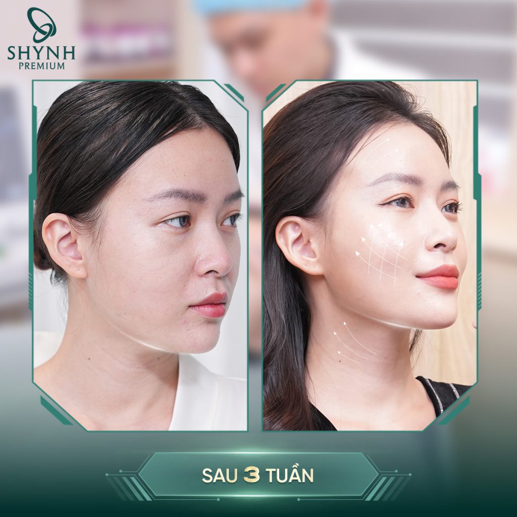 Liệu pháp Shynh Ulthera tác động sâu, giúp nâng cơ rõ rệt cho khách hàng
