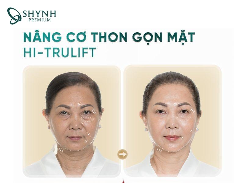 Hình ảnh thay đổi của khách hàng Shynh Premium sau điều trị bằng Hi-Trulift