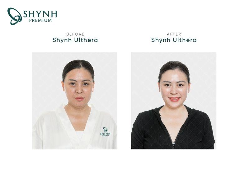 Da mặt khách hàng săn chắc, trẻ trung hơn sau liệu pháp Shynh Ulthera