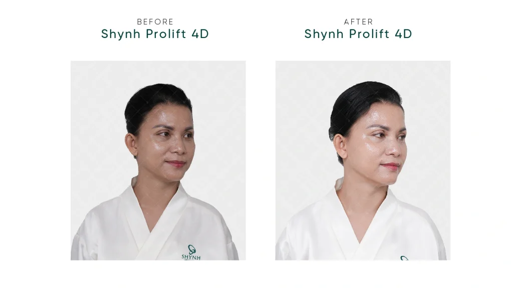 Hình ảnh khách hàng tại Shynh Premium sử dụng Shynh Prolift 4D