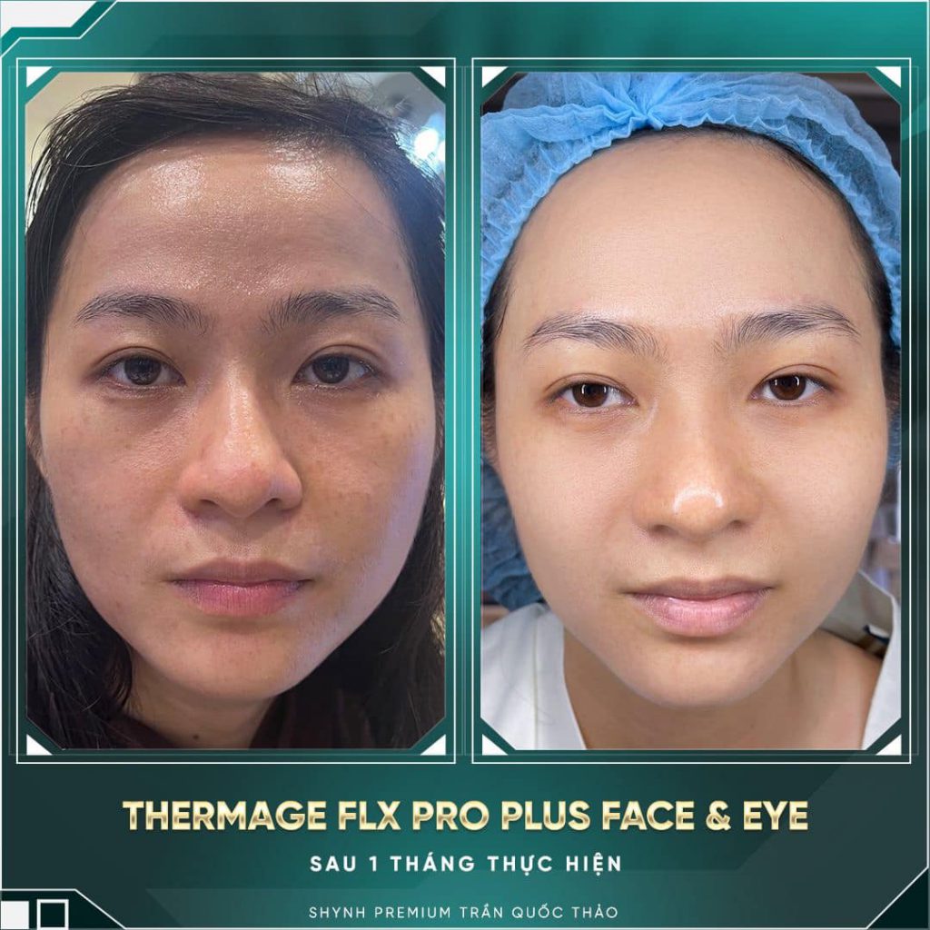 Thermage FLX Pro Plus trả lại làn da săn chắc cho khách hàng tại Shynh Premium